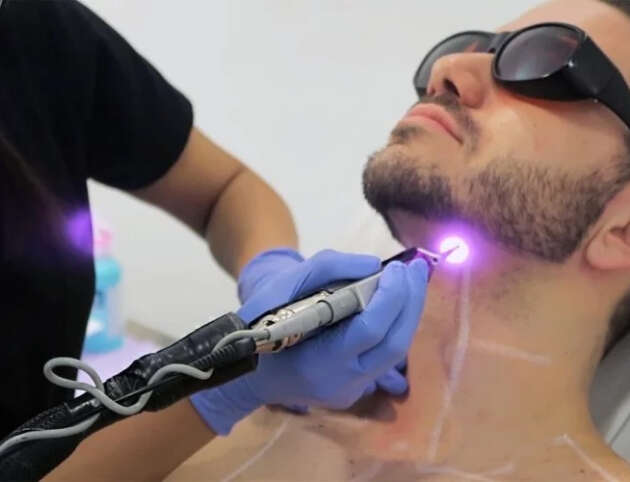 laser hair removal men